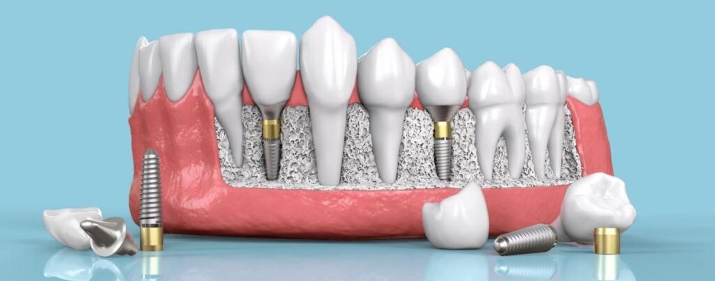 Top 10 địa chỉ làm răng giả tốt nhất tại TPHCM